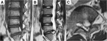 A herniated, or slipped, disk is a common condition that can be painful and debilitating. Prolapsed Lumbar Disc In A Nine Years Old Girl A Case Report Egyptian Journal Of Neurosurgery Full Text