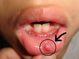 Maybe you would like to learn more about one of these? How To Get Rid Of Pimples Fast How To Get Rid Of Pimple Overnight