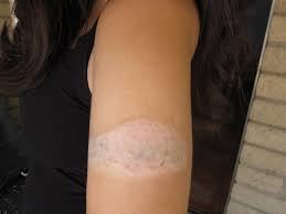 Hydrogen peroxide will lighten and fade your tattoo. Remove Tattoo Hydrogen Peroxide