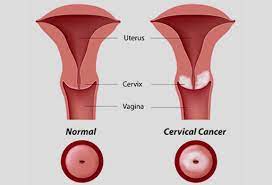 Staging aims to assess how far the cancer has spread and whether it has reached nearby structures or more distant organs. Cervical Cancer Cervical Cancer Symptoms And Treatment