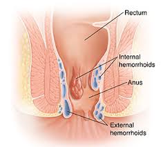 Image result for hemoroid human