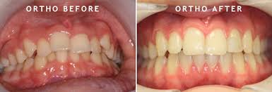 Can veneers fix my problem? How To Fix Crooked Teeth Treatment For Crooked Teeth In Mississauga