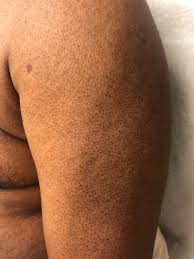 Image result for Diffuse Hyperpigmentation