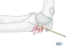 'the olecranon is the bony landmark identified as the elbow in surface anatomy.' 'patients with longstanding gout may have tophi over the olecranon prominence, first metatarsal joints, or pinnae.' Plate Fixation Of Multifragmentary Olecranon Fracture