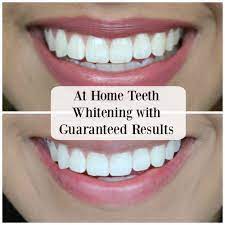 Thousands of dental professionals all over the world rely on us for our support of their bleaching services.simplicity for you and your patients is the goal that has guided the development of our product line. Pin On Teeth Whitening Before After Results