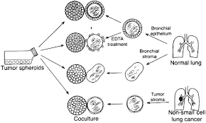 Large carcinoids can cause partial or complete blockage of an air passage, which can lead to pneumonia (an infection in the lung). Invasiveness By Lacz Transfected Non Small Cell Lung Cancer Cells Into Human Bronchial Tissues In Vitro Lung Cancer