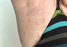 How To Get Rid Of Razor Bumps Easily | 99 Cent Razor