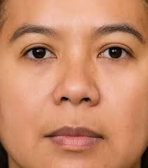 Buy Pure Hydroquinone 4% Cream for Skin Whitening Online