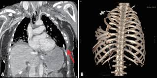 Image result for Flail Chest