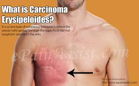 It grows slowly and rarely spreads. What Is Carcinoma Erysipeloides How Is It Treated Causes Symptoms Life Expectancy Prognosis Of Carcinoma Erysipeloides