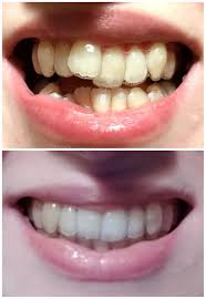 These patients need teeth straightening again because they didn't consistently wear their retainers. Tray 1 To Retainers 31 Trays Later Finally Smiling Invisalign