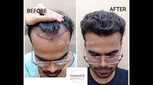 Best Hair Transplant Clinic in Bandra