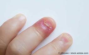 Erfahre mehr über.behandlungsmöglichkeiten unterschiedlicher warzen. Fibrome Meine Gesundheit