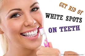 Spit out the oil and wash your mouth with warm water. 14 Ways To Get Rid Of White Spots On Teeth Fast Naturally Scrappybook