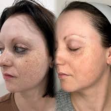 A journey to an even, brighter tone...