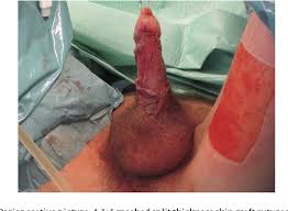 Résultat de recherche d'images pour "penis degloved"