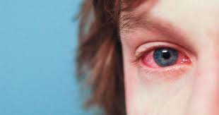 Mata merah ini mengindikasikan terjadinya masalah di mata anda, masalah tersebut bisa berupa masalah ringan hingga yang cukup serius. Mata Merah Pada Anak Ini Penyebab Dan Cara Mengatasinya Popmama Com