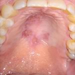 Image result for oral herpes symptoms roof of the mouth