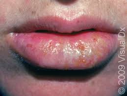 Image result for oral herpes symptoms roof of the mouth