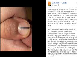 Brown usually appears as a line or streak going up and down the nail. Woman Shares Warning That Black Line On Nail Could Be Sign Of Cancer The Independent The Independent