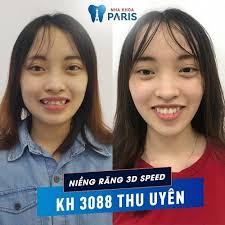 Văn bản trên thuộc thể loại nào? Niá»ng RÄng Ä'áº¹p Cá»¡ Nao Hinh áº£nh TrÆ°á»c Va Sau Khi Niá»ng RÄng Táº¡i Paris