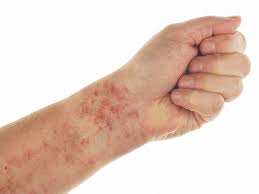 These purpura spots are caused by small hemorrhages under the skin and are not associated with abnormally low levels of platelets (nonthrombocytopenic) as is common with some other forms of purpura. Petechiae Causes Treatments Pictures And More