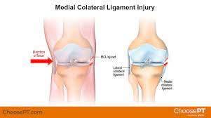 Physical Therapy Guide To Medial Collateral Ligament Mcl Injury Choosept Com