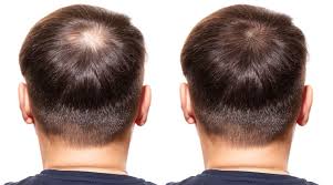 Patrick angelos, author of the science and art of hair restoration: Here Are Some Ways To Prevent Hair Fall Hestanbul