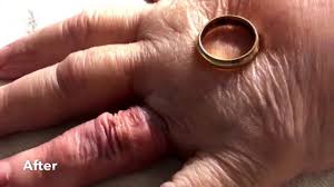 Image result for Ring Removal