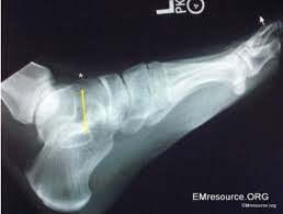 Questions and answers regarding fractures of the foot and ankle. Anterior Talus Fracture Patient Care Online