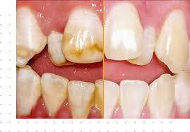 Fluorosis Dental Con Antivet En Queretaro An effective and reliable dental stain remover with. fluorosis dental con antivet en queretaro
