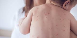 Konsumsi obat tertentu seperti penicillin 11. 10 Penyakit Kulit Pada Anak Yang Perlu Orangtua Waspadai