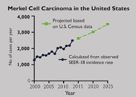 steep u s increase projected for rare skin cancer newsroom