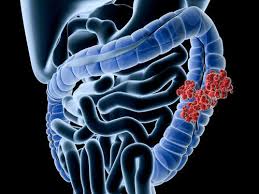 Colon cancer and rectal cancer, collectively known as colorectal cancer, have many colorectal cancer is currently the third most common cancer in both men and women. Black Panther Star Chadwick Boseman Dies Of Colon Cancer Here Is Everything You Need To Know About The Condition The Times Of India
