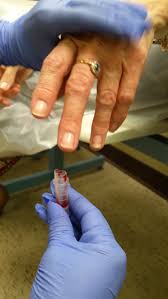 Image result for Capillary Puncture