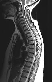 Image result for Myelitis