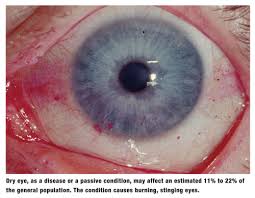 Image result for Dry Eye