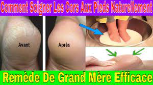 Le cor au pied : Comment Soigner Les Cors Aux Pieds Naturellement Remede De Grand Mere Youtube