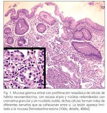 Who classification of tumours of the digestive system. Tumor Carcinoide Gastrico Solitario Y Anemia Perniciosa Tratamiento Mediante Polipectomia Endoscopica