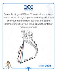 Image result for Pelvimetry