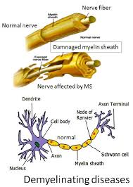 Demyelinating disorders of the brain and spinal cord. Demyelinating Diseases