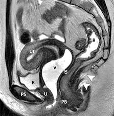 This is the sixth in a series of 8 blog post articles on the anatomy and physiology of the lumbar spine and pelvis. Translabial Us And Dynamic Mr Imaging Of The Pelvic Floor Normal Anatomy And Dysfunction Radiographics