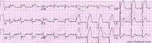 Image result for icd 10 code for acute myocardial infarction anterior wall