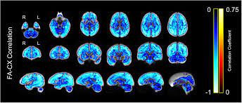 View latest posts and stories by @voxel_rl in instagram. Age Related Differences In White Matter Understanding Tensor Based Results Using Fixel Based Analysis Biorxiv