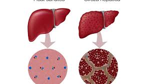 Majoritatea oamenilor nici nu realizează că au o splină mărită deoarece simptomele apar rar; Ciroza Hepatica Reginamaria Ro
