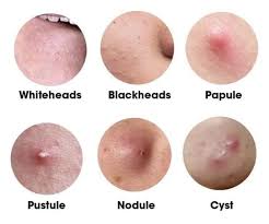 Image result for Nodule