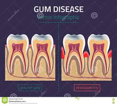 Gum Disease Vector Stock Vector Illustration Of Periodontal