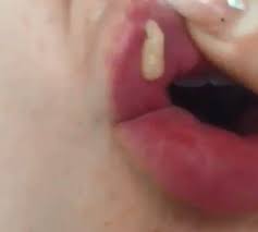 Horrifying Video Reveals What Happens When Lip Fillers Go Wrong If you don't know what caused the. when lip fillers go wrong