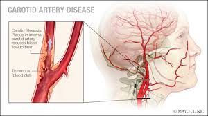 Image result for carotid artery