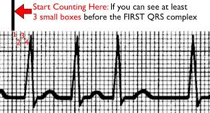Image result for QRS Complex